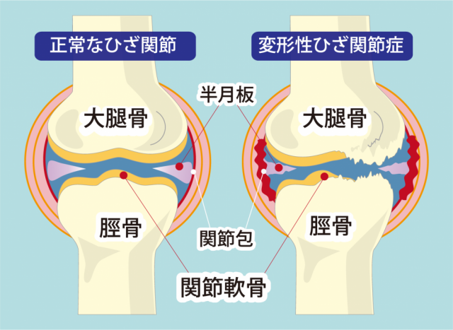 膝関節症のイラスト